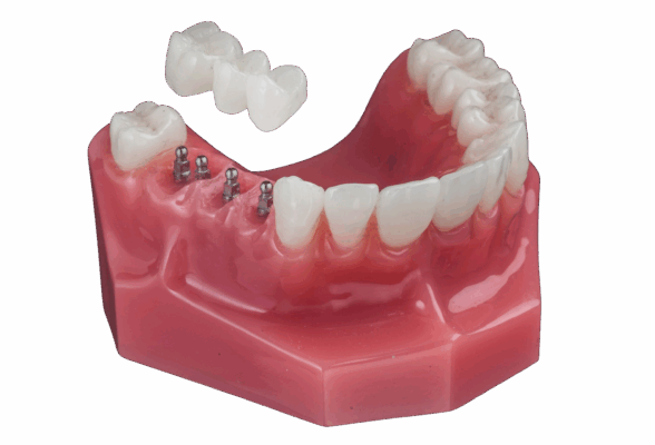 Puente dental en Idaho Falls, ID | Reserve una consulta gratuita hoy.