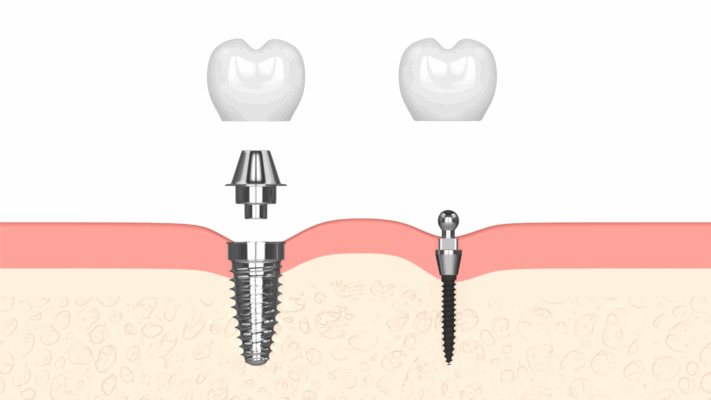 Implantes Dentales en Idaho Falls, ID | Programe una consulta GRATIS