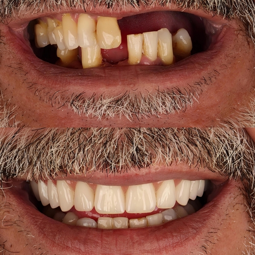 Full-Mouth Reconstruction in Idaho Falls, ID | Free Consultations