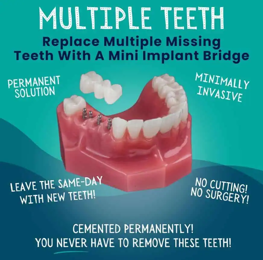 Multiple-Teeth-Replacement-Idaho-Falls-ID