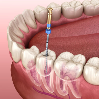 Root Canal Treatment in Idaho Falls, ID | Book a Free Consultation