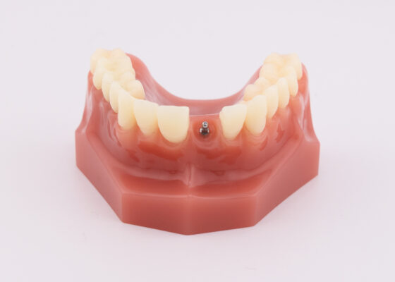 Same-Day Dental Implants in Idaho Falls, ID | Free Consultations