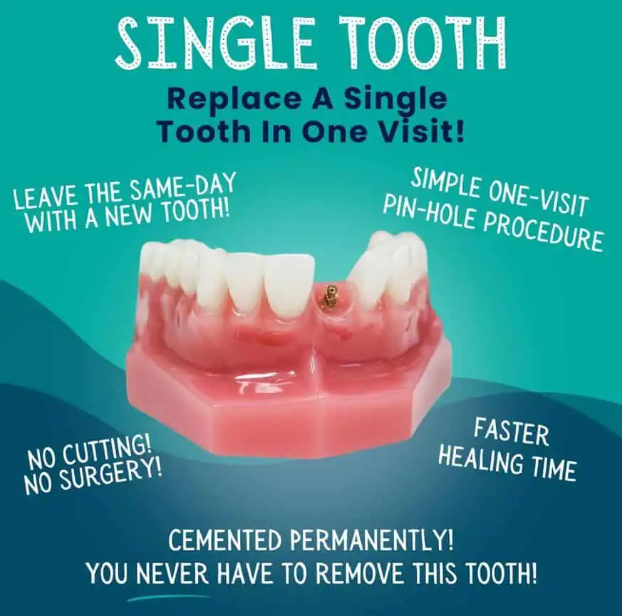Single-Tooth-Replacement-Idaho-Falls-ID