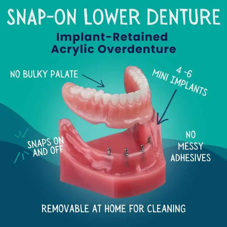 Snap-On-Lower-Denture-Idaho-Falls-ID