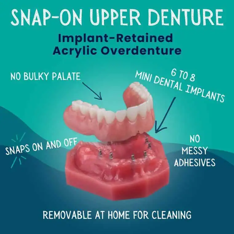 Snap-On-Upper-Deture-Idaho-Falls-ID