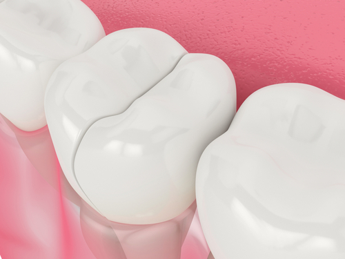 Dental Bonding | Restorative Dentistry in Idaho Falls, ID