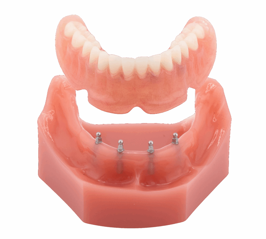 ¡Dentaduras Snap-In en Idaho Falls, ID | Reserve una consulta gratis! 📅