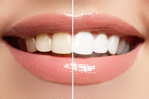 Teeth Whitening Myths Cosmetic Dentistry in Idaho Falls ID 5
