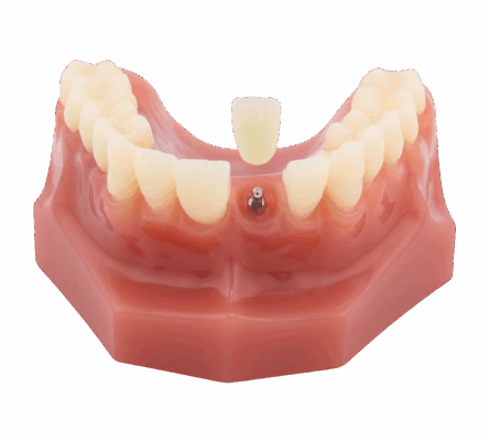 Teeth in a Day in Idaho Falls, ID | Book a Free Implant Consultation