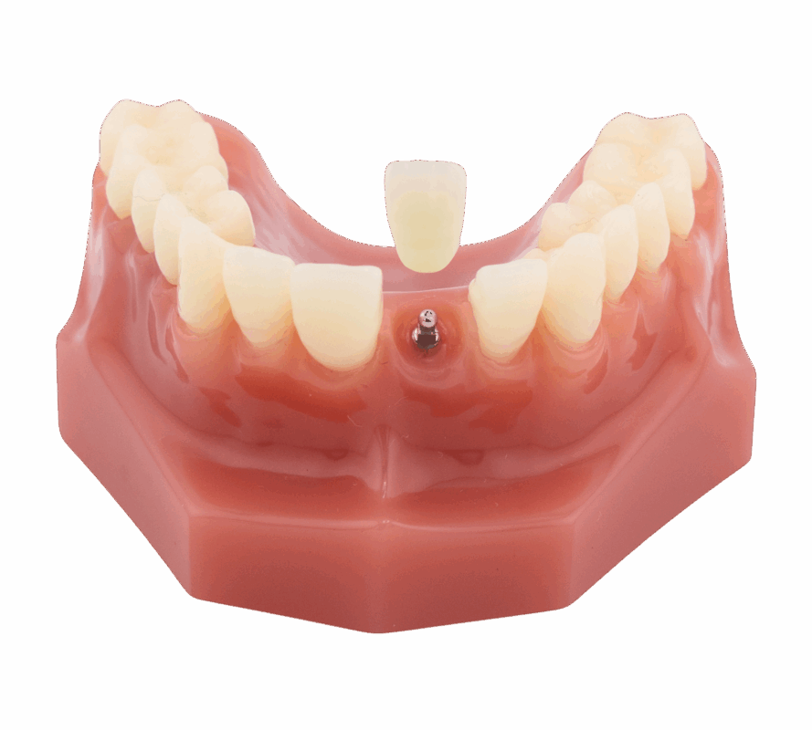 Teeth in a Day in Idaho Falls, ID | Book a Free Implant Consultation