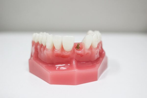 Extracción dental en Idaho Falls | Consultas gratuitas sobre mini implantes dentales