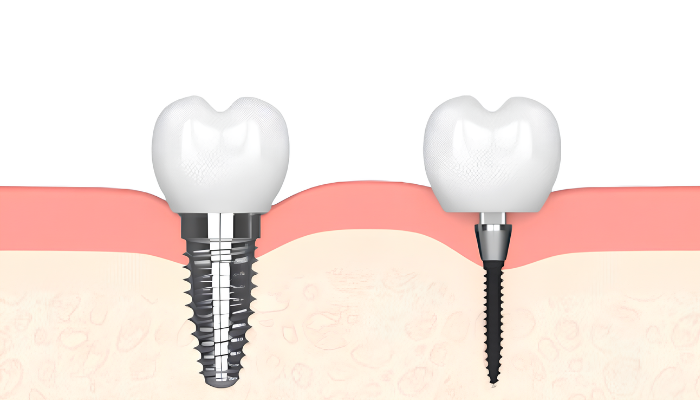 Dental Implant Financing in Idaho Falls, ID | Free Implant Consults
