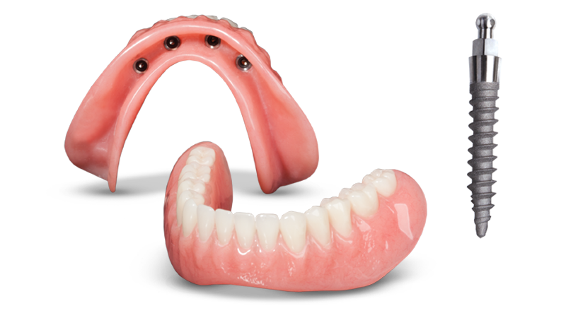 Floating Dentures in Idaho Falls, ID | Free Implant Consultations