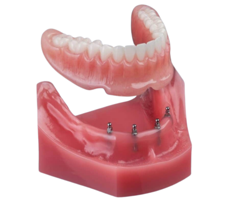 Snap-On Dentures in Idaho Falls, ID | Free Consult [Video Q&A]