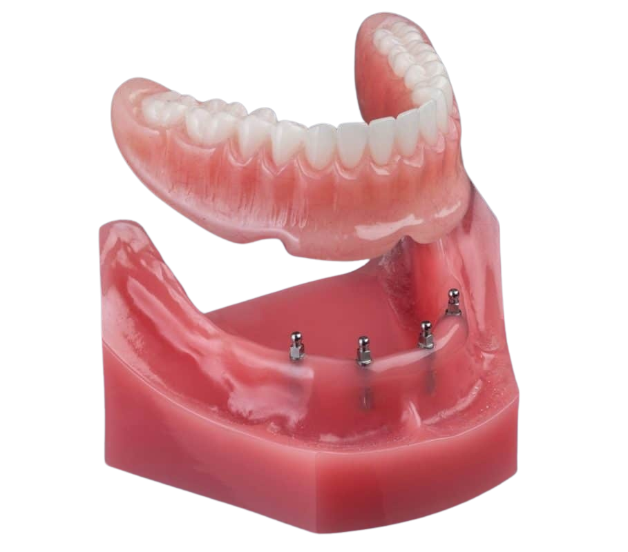 Snap-On Dentures in Idaho Falls, ID | Free Consult [Video Q&A]