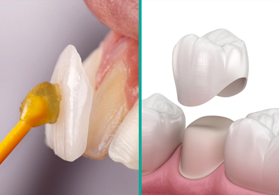Veneers vs. Crowns Affordable Cosmetic Dentistry in Rigby, ID