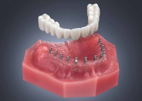 Permanent Dentures in Idaho Falls, ID [Expert Video Explainer]