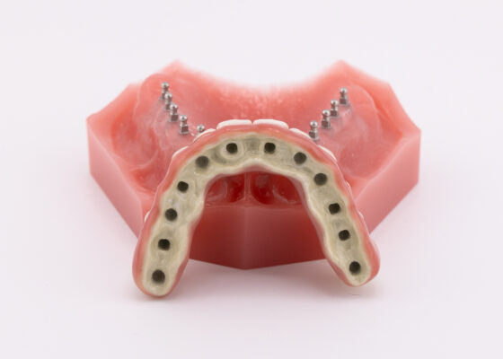 Permanent Denture in Rigby, Idaho | Book a FREE Consultation