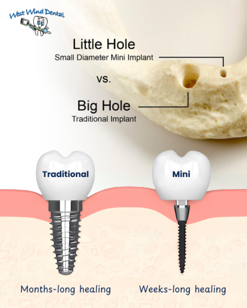Miniimplantes dentales en Idaho Falls, ID. Reserva una consulta GRATIS