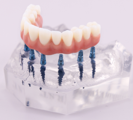 Mono Dental Implants in Idaho Falls, ID | Book a Free Consultation