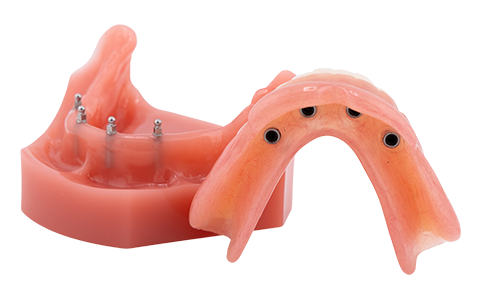 Overdentures in Idaho Falls, ID Book a FREE Consultation Today! 2