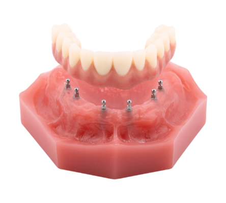Implantes dentales Fix-on-Six en Idaho Falls, ID | Reserva una consulta gratuita