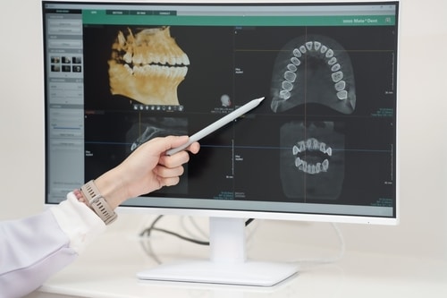 Rexburg Implant Dentist in Idaho Book a Free Consultation Today