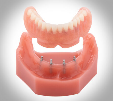 Mini Dentures in Rigby, Idaho Affordable Dental Implant Dentures 2